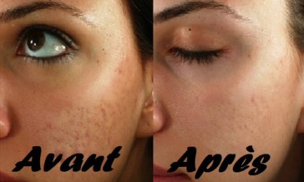 Les meilleurs traitements pour les cicatrices d’acné