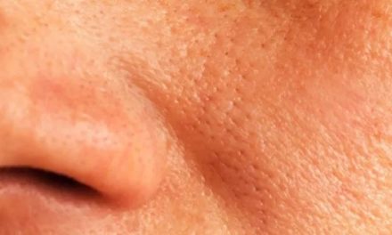 7 remèdes naturels pour réduire les pores dilatés du visage