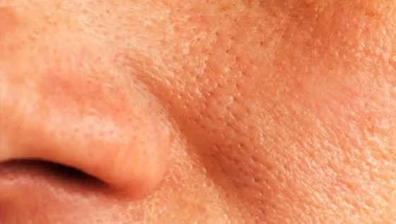 7 remèdes naturels pour réduire les pores dilatés du visage