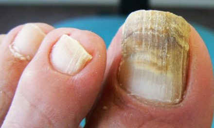 3 Remèdes naturels pour la mycose des ongles : Traitement de la teigne