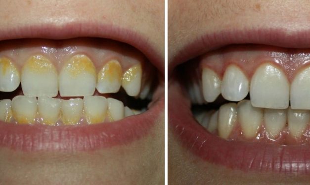 Plaque dentaire : l’enlever et faire un détartrage naturel