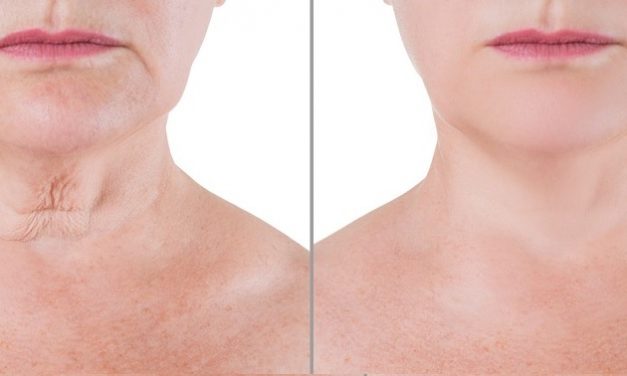 Lifter le cou et le visage sans chirurgie : Eviter le relâchement de la peau