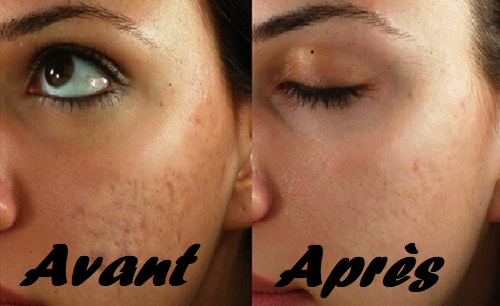 Les meilleurs traitements pour les cicatrices d’acné