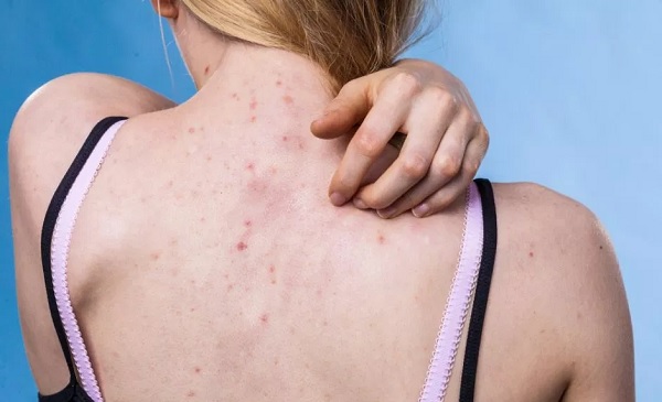 Comment se débarrasser de l’acné sur le dos et du visage